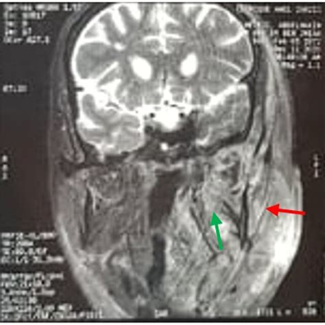 Photograph Of The Patient Showing Spontaneous Anterior Detachment Of