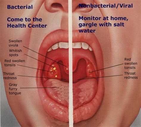 Tonsillitis Symptoms Health Fitness