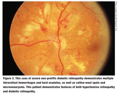 Retinopathy: Stages Of Hypertensive Retinopathy