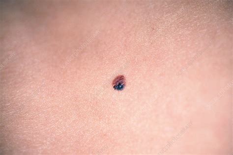 Dysplastic Nevus Stock Image C043 0703 Science Photo Library