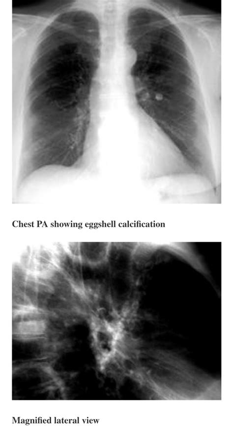 Calcification Of Lymph Nodes