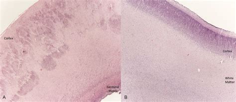 A Histology Shows The Typical Cobblestone Pattern Of The Cerebral