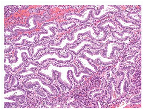 Uterine Corpus Epithelial Lesions Basicmedical Key