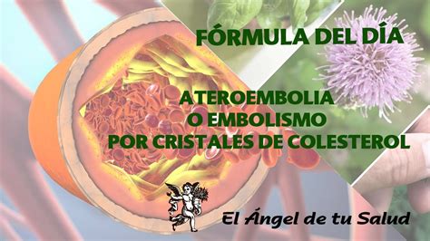 F Rmula Herbolaria Para Tratar Ateroembolia O Embolismo Por Cristales