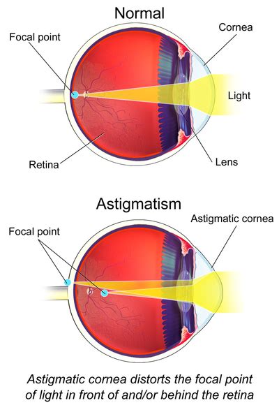 Can Astigmatism Be Corrected 20 Causes Symptoms Types And Treatments