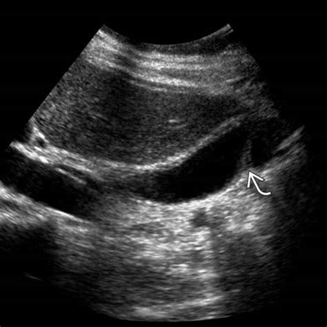 Congenital Abnormalities Of The Gallbladder Radiology Key