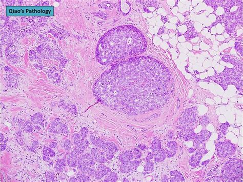 Qiaos Pathology Solid Papillary Carcinoma Of The Breast With Copresence Of Invasive Ductal