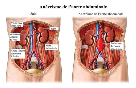 Chirurgie Vasculaire Ccvt Chu De Li Ge