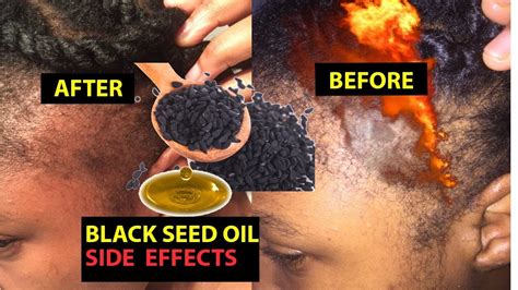 How To Use Black Seed Oil For Hair Growth And Prevent Hair Fall Youtube