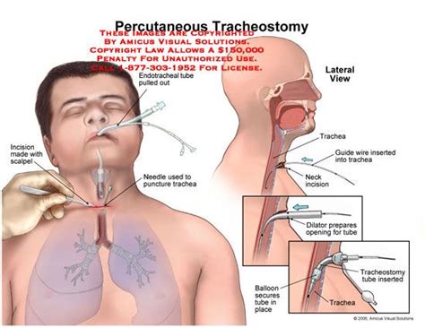 Percutaneous Tracheostomy Tracheostomy Medical Tracheostomy Tube