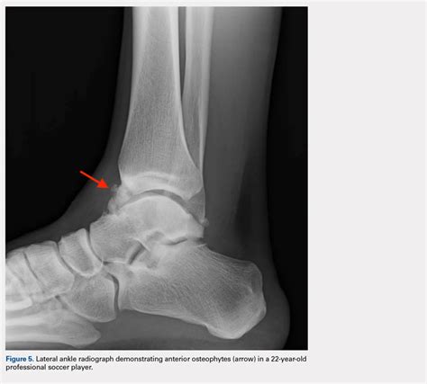 Foot And Ankle Injuries In Soccer Mdedge Surgery