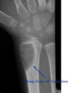 Osteoblastom Radiologie