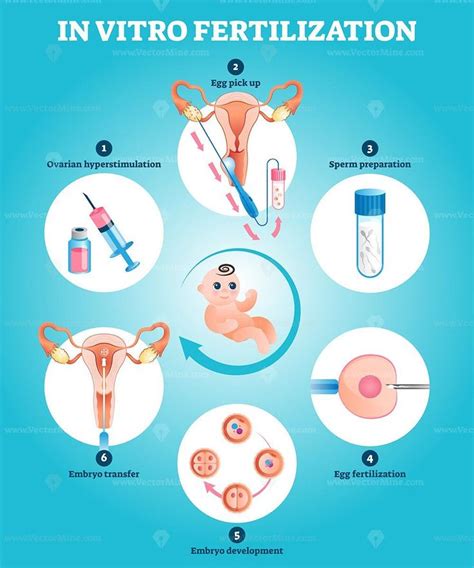 In Vitro Fertilization Artificial Pregnancy Reproduction Vector Illustration Vectormine In