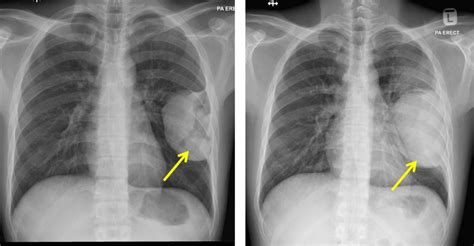 Pleural Based Mass Radiology Cases