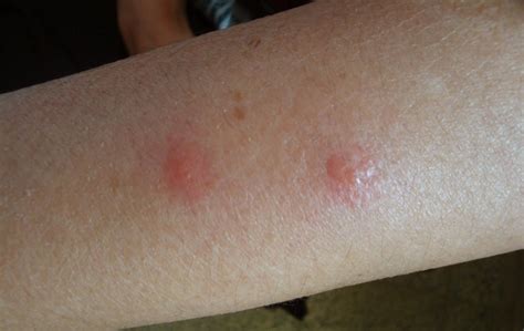 Papular Urticaria Picture Pictures Photos
