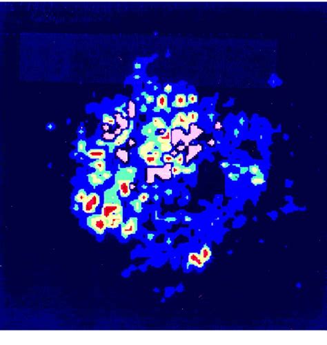 High Resolution Laser Doppler Perfusion Imaging Aids In Differentiating