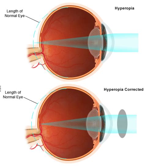 Hyperopia - The Human Eye