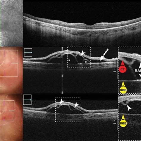 Bacillary Layer Detachment Associated With Exudative Neovascular Amd