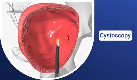 Cystoscopy A Step By Step Overview