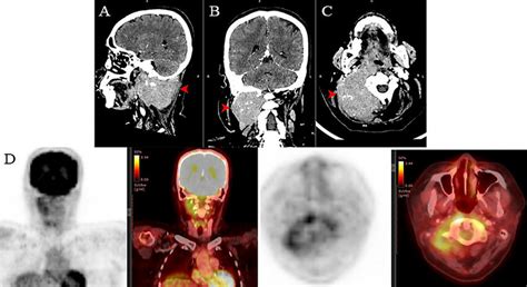 Cervical CT Scan Performed Before The Initiation Of Brentuximab Vedotin