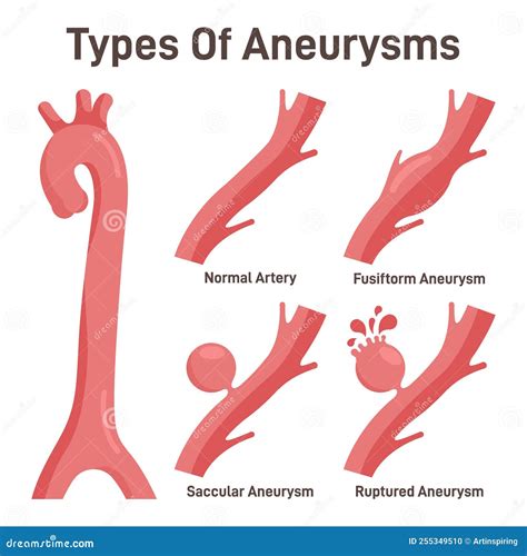 Thoracic Aortic Aneurysm Classification