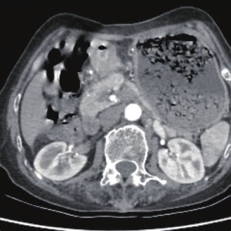 Abdominal Computed Tomography Showed Gastric Antrum Wall Was Slightly