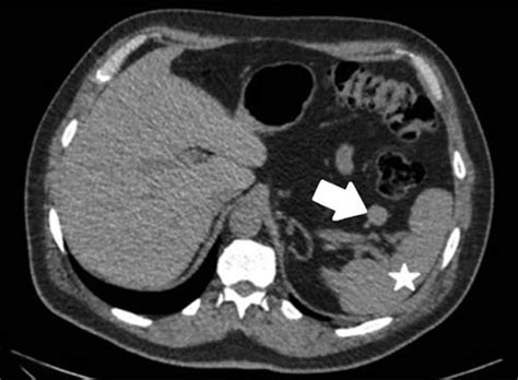 Ct Scan Of Accessory Spleen At Splenic Hilus Accessory Spleen Arrow