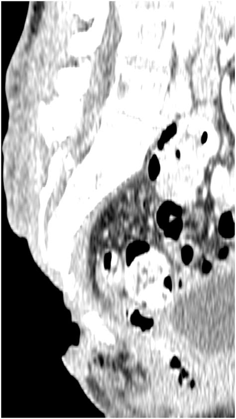 Preoperative Computed Tomography Scan Showing The Three Dimensional Download Scientific