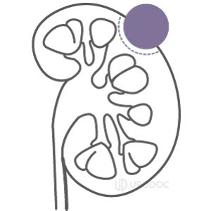 partial nephrectomy urodoc