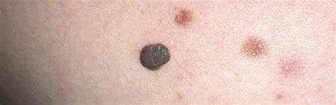 Itchy moles on back, should I be worried? I don’t have insurance and it’s hard to find drs that ...