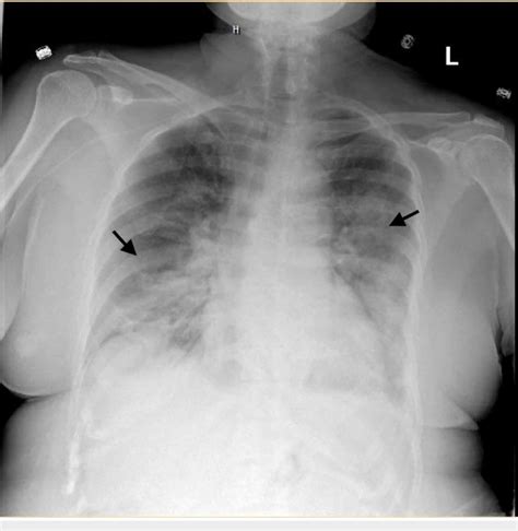 Portable Chest X Ray Of The Patient Chest X Ray Showing Bilateral