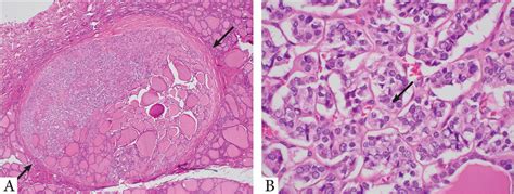 Forty-nine-year-old female with a 0.35 cm noninvasive follicular... | Download Scientific Diagram