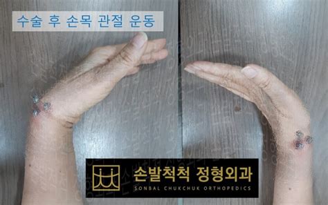 손발척척 정형외과 수술센터 수술센터 수술센터 손목골절수술원위요골골절수술수술후재활