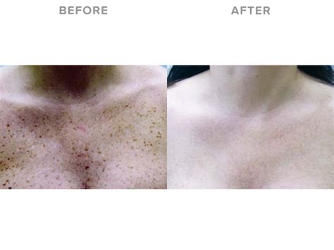 Pigmentation Removal With Candela Gentlelase Pro Eden Laser Clinics