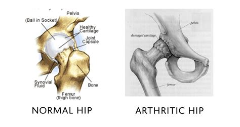 Hip Joint Diagram