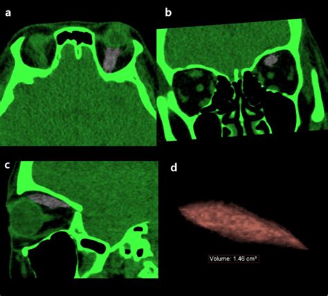 Multiplanar Three Dimensional Reconstruction Of A Computed Tomography Download Scientific