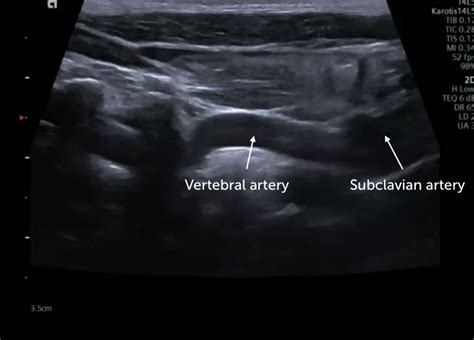 13 Vertebral Artery Pathologies 123sonography