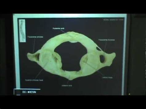 Transverse Foramen