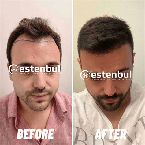 Hair Transplant Cost Turkey 2024 Estenbul Health