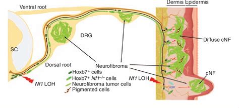 Figure 1 from New insights into the neurofibroma tumor cells of origin ...