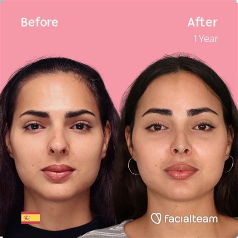 Felicitas Before And After Ffs Surgery Facialteam