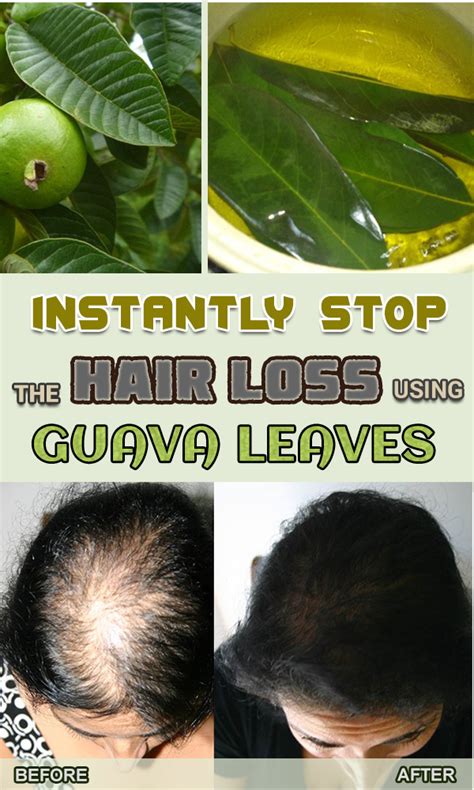 Pin On Hair Loss