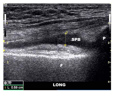 Figure From Ultrasonographic Findings In Knee Osteoarthritis A