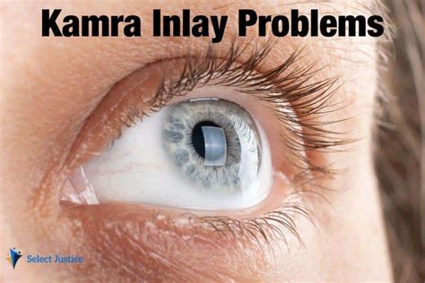 Kamra Corneal Inlay Surgery Lawsuit January Select Justice