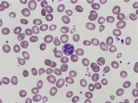 Anisocytosis Macroovalocytosis Hypersegmentation Of Neutrophils In