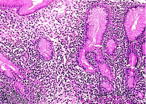 Photomicrograph Of The Gastric Biopsy Dense Lymphoplasmacytic