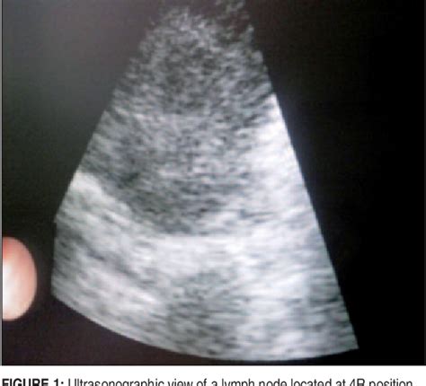 Figure 1 From Role Of Real Time Endobronchial Ultrasound Guided