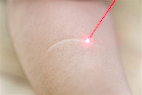 Laser Treatment For Keloids Get The Best Resultsnon Ablative Lasers Awd Med