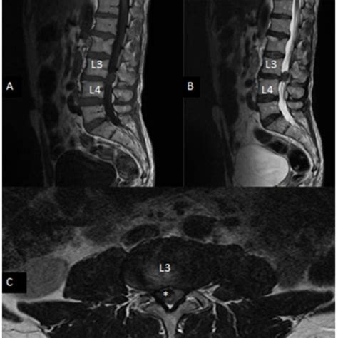 Sagittal T1 A Sagittal T2 B And Axial C T1 Weighted Mr Images