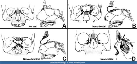 Cephaloceles Medlink Neurology